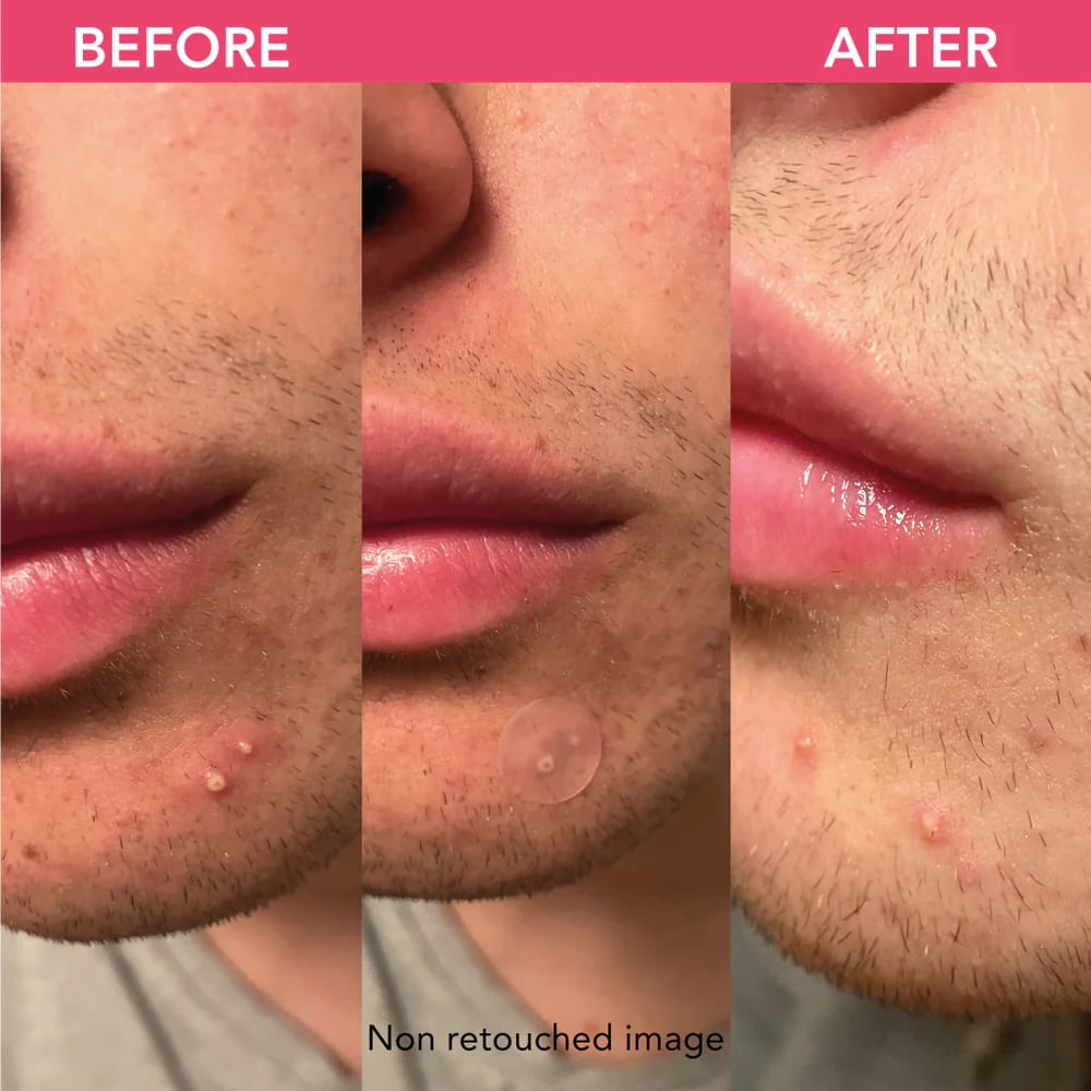 Vorher-Nachher-Bild eines unretuschierten Gesichts mit Akne, das die Verbesserung der Haut nach der Behandlung zeigt.