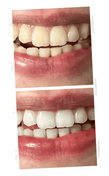 ONLYSMILE Zahnaufhellungsgel