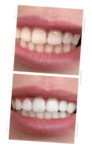 ONLYSMILE Zahnaufhellungspulver